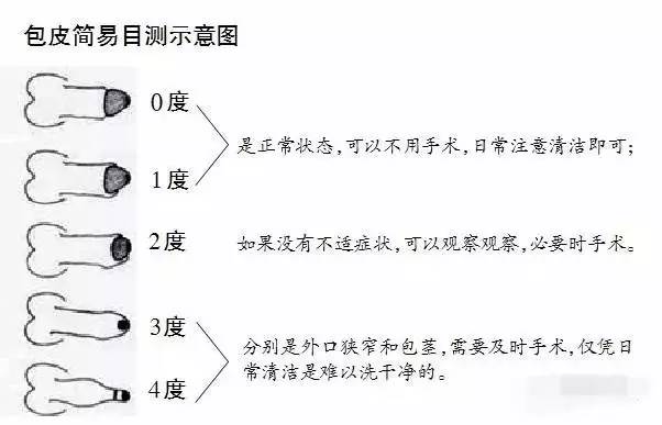 02 包皮什么时候割好? 理论上,各个年龄段都可以割包皮.