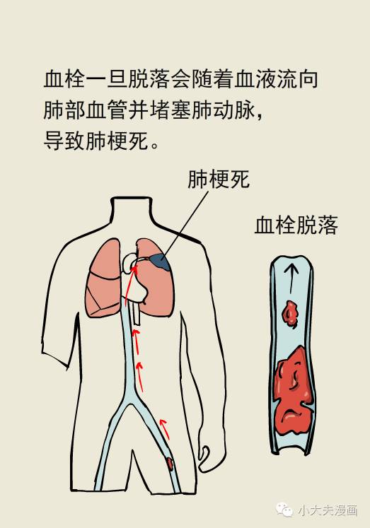 看电视一坐好几个小时,会招来肺梗死!