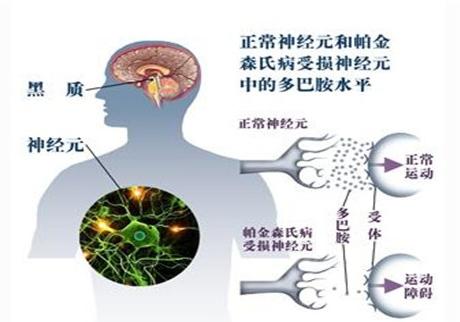 帕金森病怎么艾灸？帕金森病的艾灸治疗方法 .艾灸养生