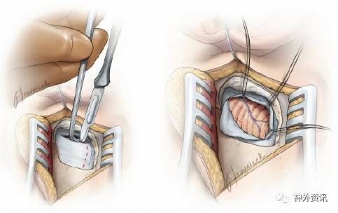 乙状窦后入路| the neurosurgical atlas系列