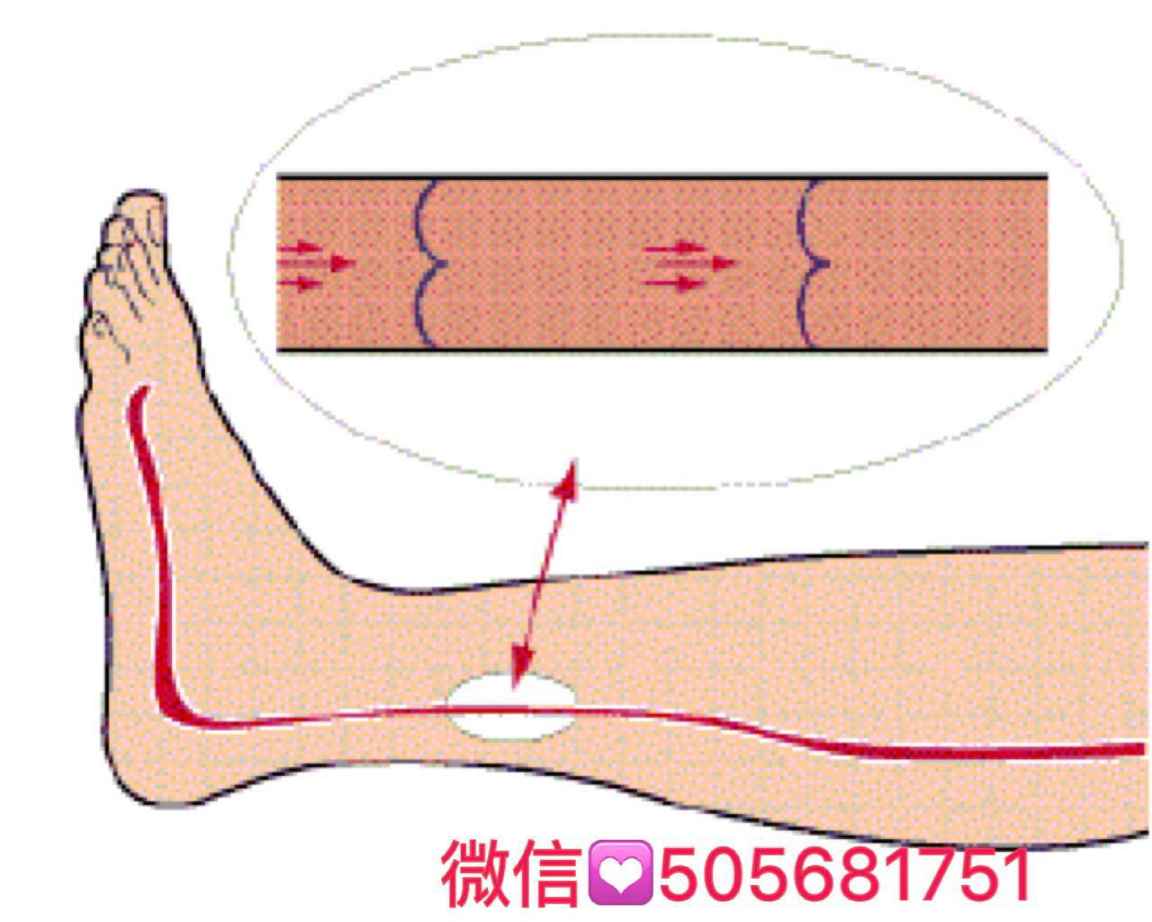 有血栓的人口比例_腿上有血栓真人图片(2)