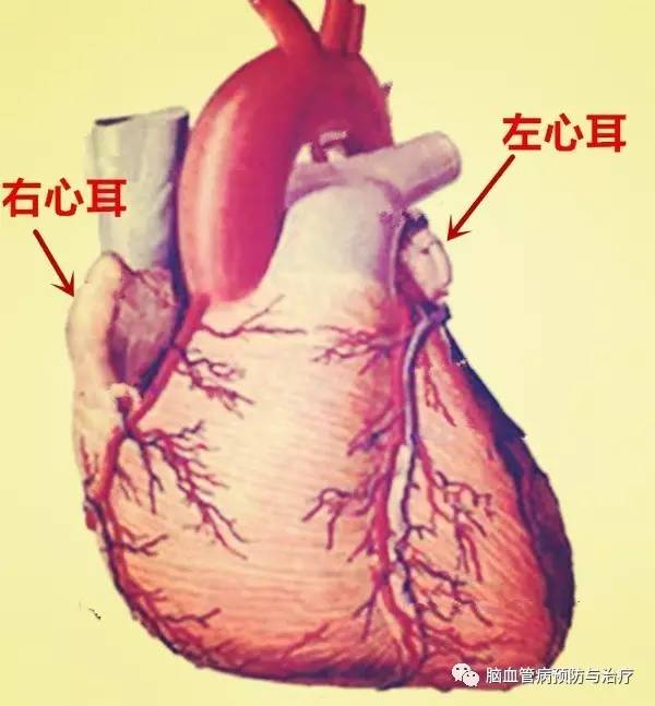 而且左心耳结构狭长,弯曲呈管状形态,有研究显示左心