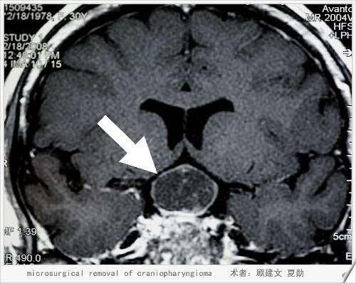 颅咽管瘤导致失明的手术治疗