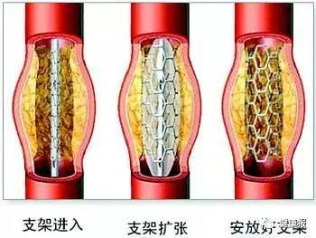 植入支架就万事大吉?心梗患者术后最该注意啥