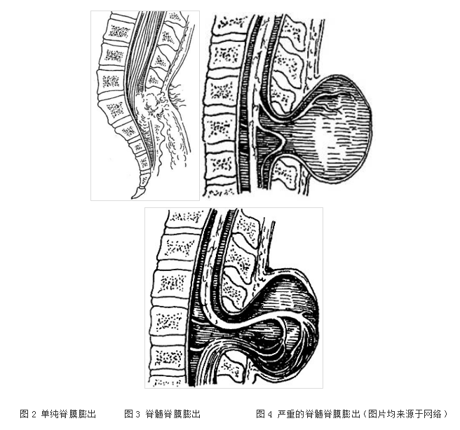 脊膜膨出严重程度与脊髓圆锥的位置关系重大