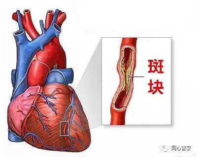 冠状动脉内的不稳定斑块极易破损,破裂,导致血栓形成.