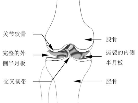 受损的半月板