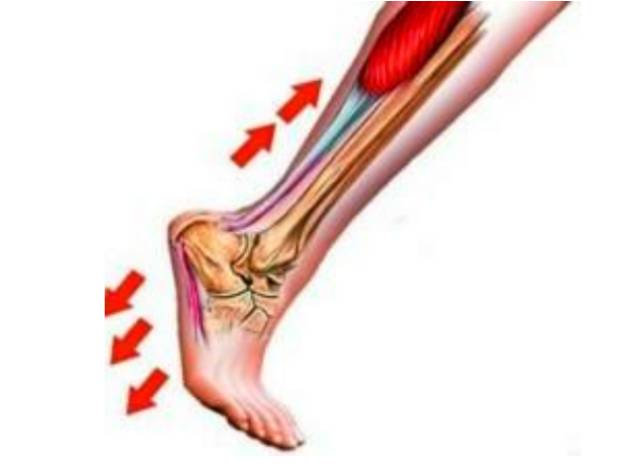 足底筋膜炎的原因 背屈活动受限 小腿肌肉紧张