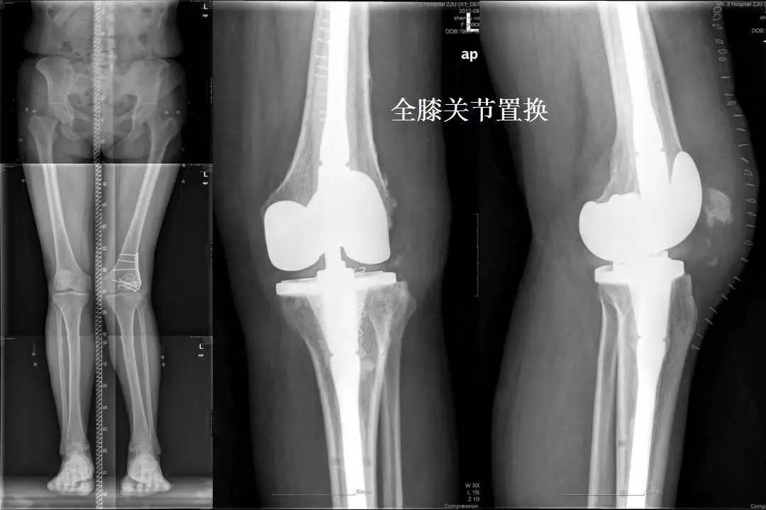 全膝关节置换术并不可怕术后病人可恢复行走