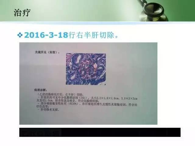 肿瘤经典病例集锦结直肠癌同时性肝转移诊治策略