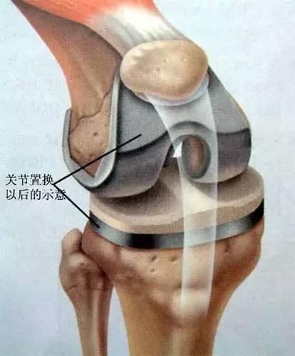 全膝关节置换术并不可怕 术后病人可恢复行走