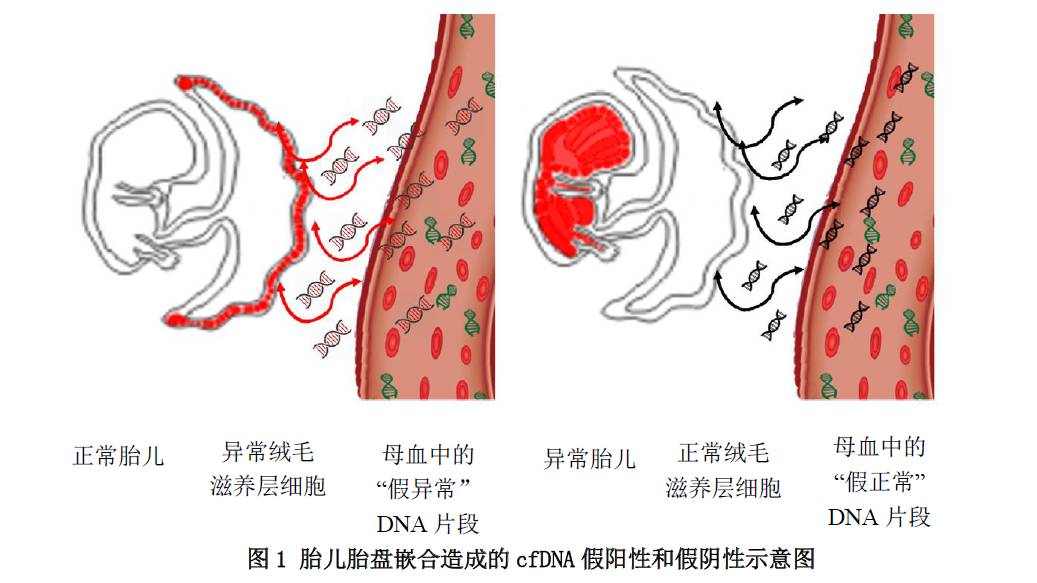 胎儿胎盘嵌合对胎儿游离dna检测的影响