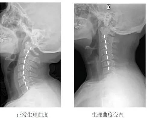 脖子痛怎么办可以缓解疼痛