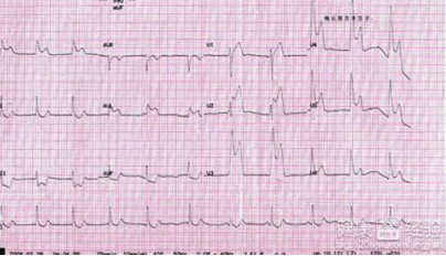 好朋友心电图机家用100法-心绞痛如何确定诱因