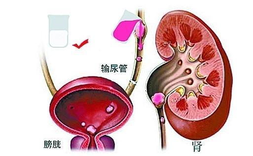 导致输尿管结石的原因