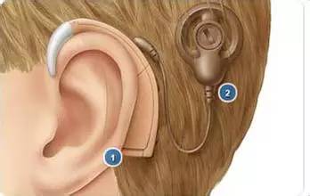 人工耳蜗使聋哑人彻底告别了无声世界