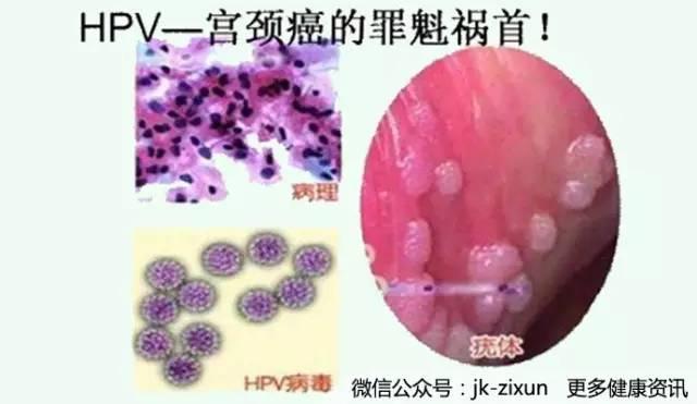 "为什么同样感染了hpv病毒,她三个月就转阴了,我都治了大半年还没有