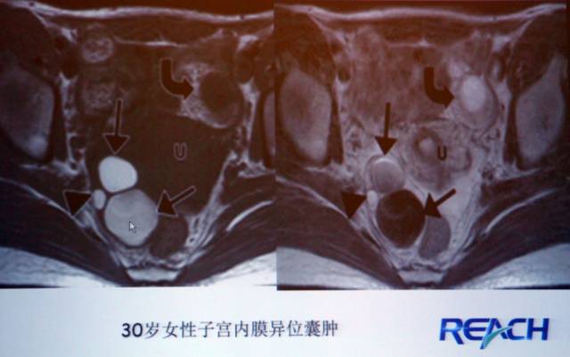 卵巢囊性病变,如何诊断?