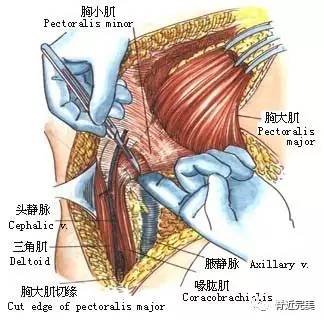 【专业分享】上交叉入手,治疗肩关节活动受限