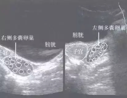 陈主任给出了较科学的治疗方案,为于女士采用腹腔镜下多囊卵巢打孔