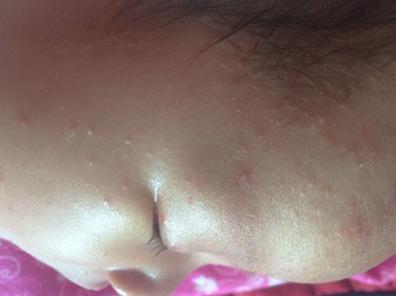 宝宝痱子和湿疹的症状图片