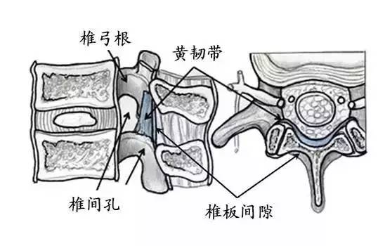 腰突克星--脊柱微创手术兵器谱之微创脊柱内镜