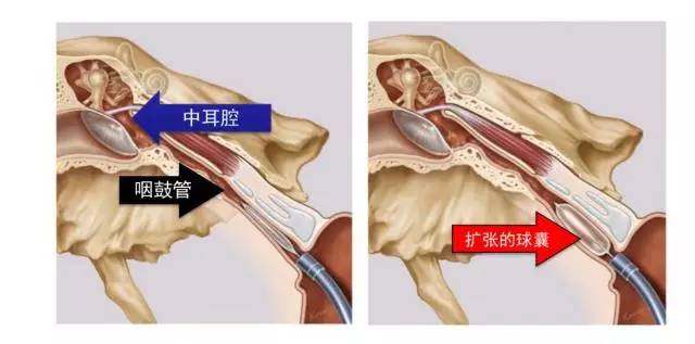 具体技术内容包括:手术操作非常简单易行,用鼻内镜经鼻腔,暴露咽鼓管