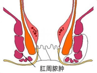 com以及肛门分泌物流到裂口处,使裂口不能愈合