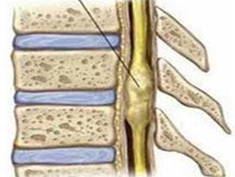 警惕:20-50岁更易患椎管肿瘤