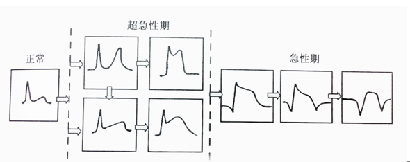 好朋友心电图机家用100法如何发现急性心肌梗死