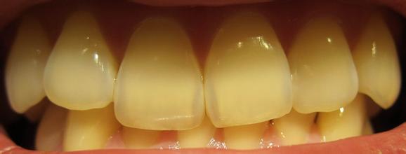 【牙齿黄】牙齿为什么会慢慢变黄