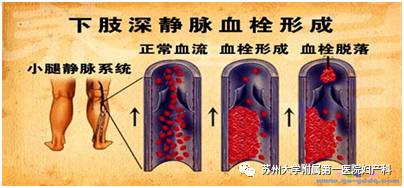 妇科手术后如何预防下肢深静脉血栓