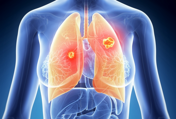 PD-1:提高非小细胞肺癌的治愈率