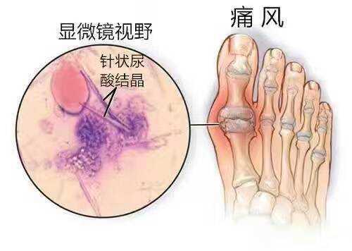 康复你的痛风不再是遥不可及的梦