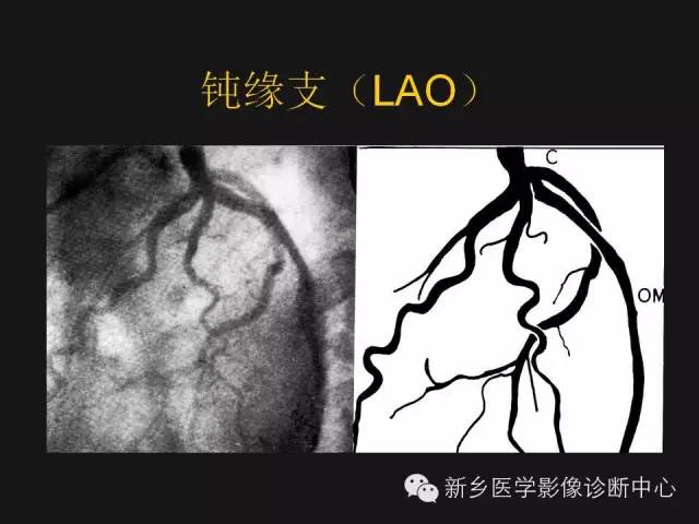 冠状动脉解剖精细到每一个分支