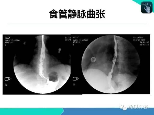 值得收藏的全套消化道钡餐图食管胃小肠结肠直肠