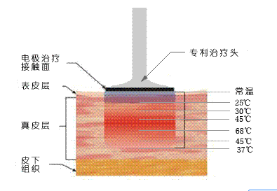 拉皮的原理是什么_外挂防封是什么原理