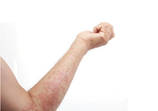 皮肤常识:治疗方法不对让湿疹加重