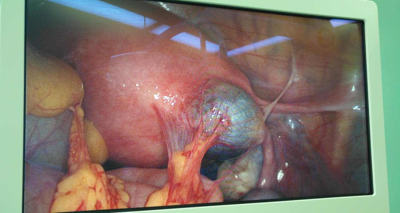 宫外孕,术中却发现孕囊着床在这个危险的部位!