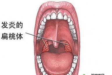 儿童扁桃体炎的病因及治疗方法