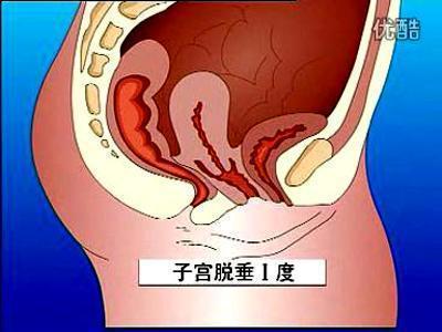 医院检查为子宫二度脱垂,阴道前壁膨出,建议手术治疗.