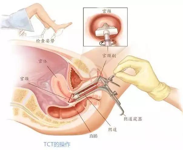 妇科体检项目多,你该怎么选?选的多不如选的对!