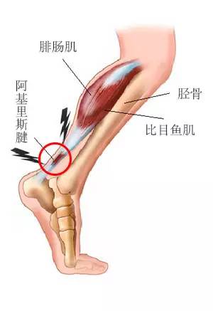 健康 正文  阿基里斯腱炎 阿基里斯腱(即跟腱)连接着两块主要的小腿