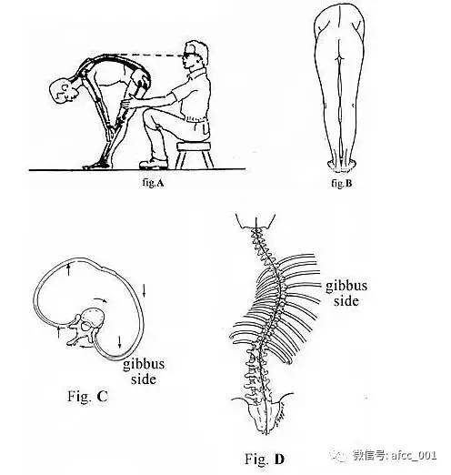 中医养生 正文 4 胸腔旋转 因为脊椎侧弯的关系〖脊柱