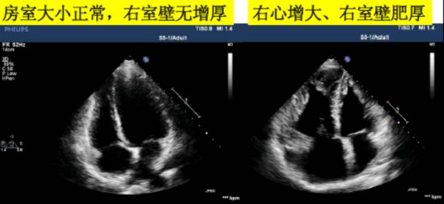 8,右室流出道的测量