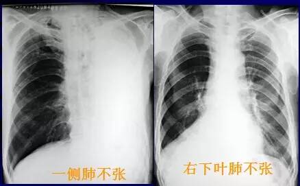 69 医学影像学讨论版 69 肺部x线病变的7种征象    ① 一侧肺不张