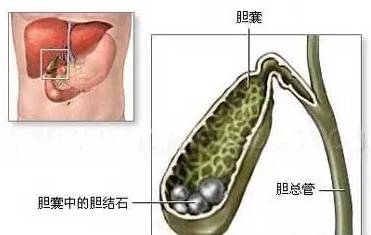 结石药的原理_所以根据我们人自身的生理特点,理论上最大横径为0.6cm以下的结石都可以用药物(2)