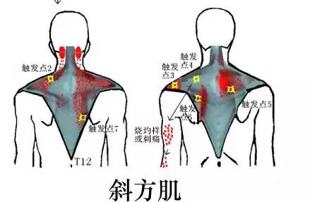 人体一般有固定的9对压痛点,换句话说这些位置每个人按起来都会有痛感