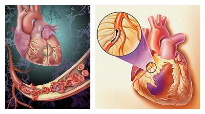 冠心病能治愈吗?