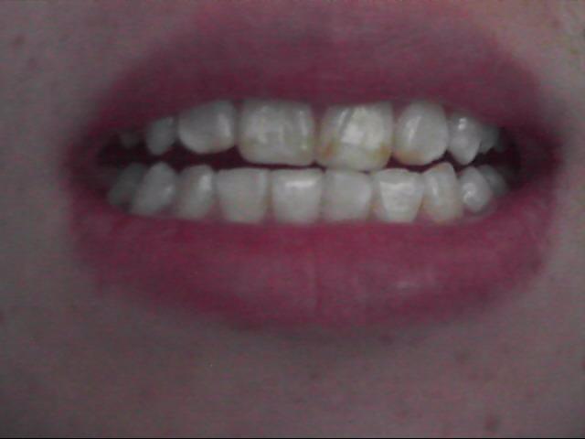 牙齿上有白斑该怎么办呢?